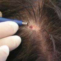 Scalp Biopsy Devices